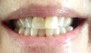 teeth before using Luster 2 Minute White dental whitening treatment kit neversaydiebeauty.com