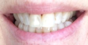 teeth after using Luster 2 Minute White Dental Treatment kit for about a week neversaydiebeauty.com