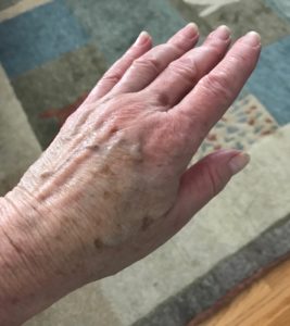 my hand after using LDC Advanced Plumping Hand Cream for 3 weeks, neversaydiebeauty.com
