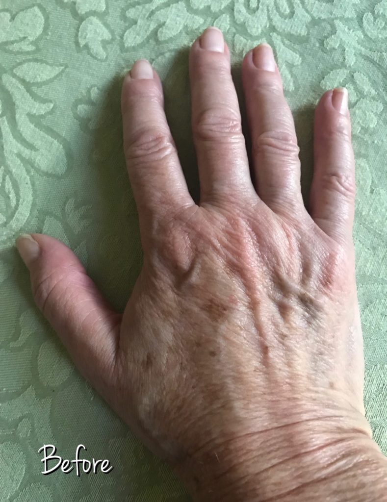 my hand before I used Parasilk gLove hand treatment, neversaydiebeauty.com