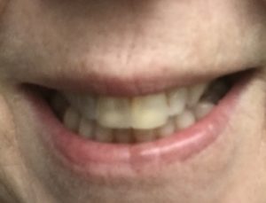 my teeth before using Luster Premium White Pro Light kit