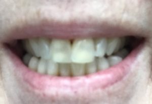 my teeth after 13 treatments with Luster Premium White Pro Light kit