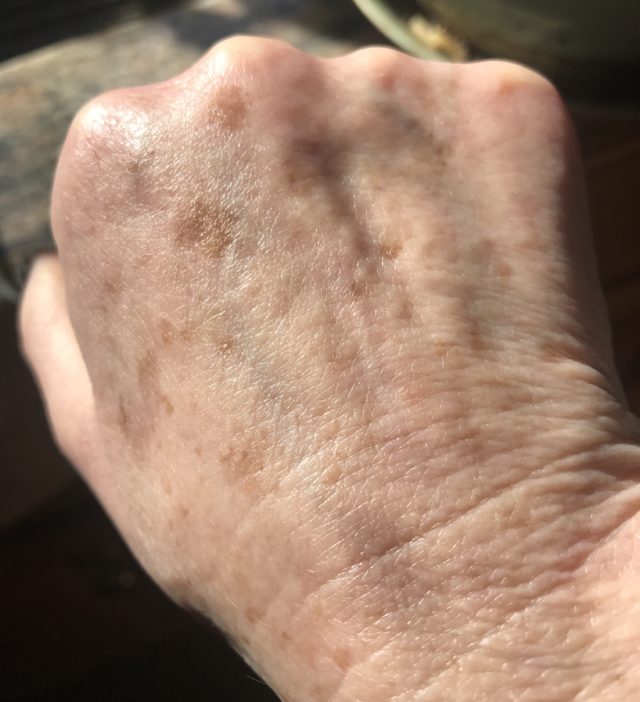 brown spots on the back of my hand, a few of which had faded somewhat